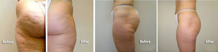 VelaShape III para la celulitis.