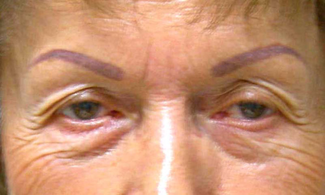 Before-Eyelid Surgery - Blepharoplasty