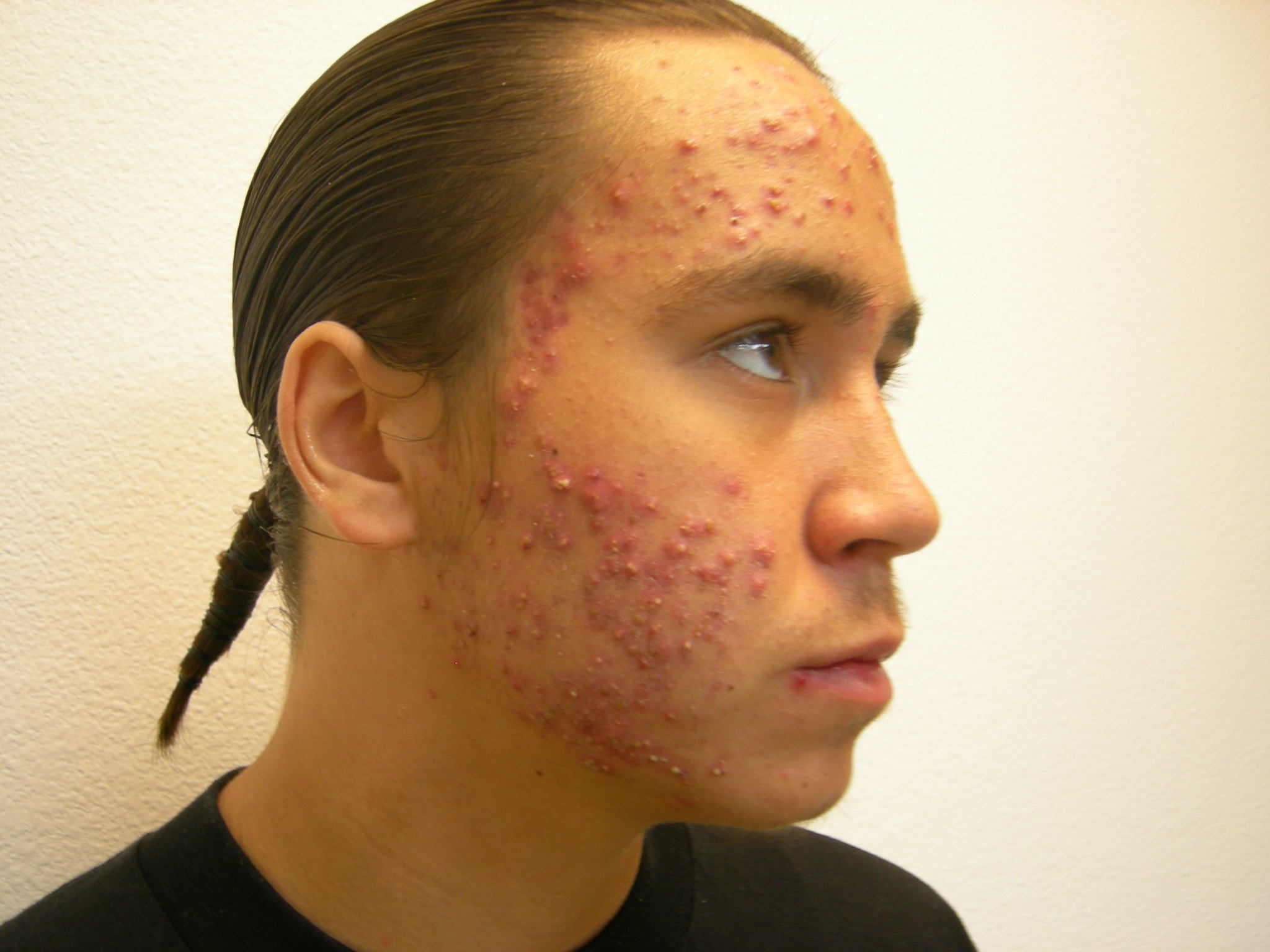 Before-Acne Scars and Scar Treatment