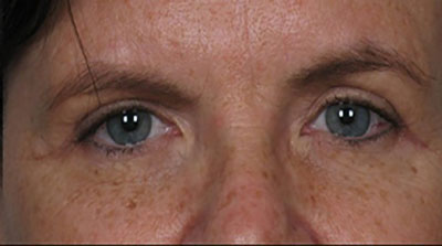 After-Eyelid Surgery - Blepharoplasty