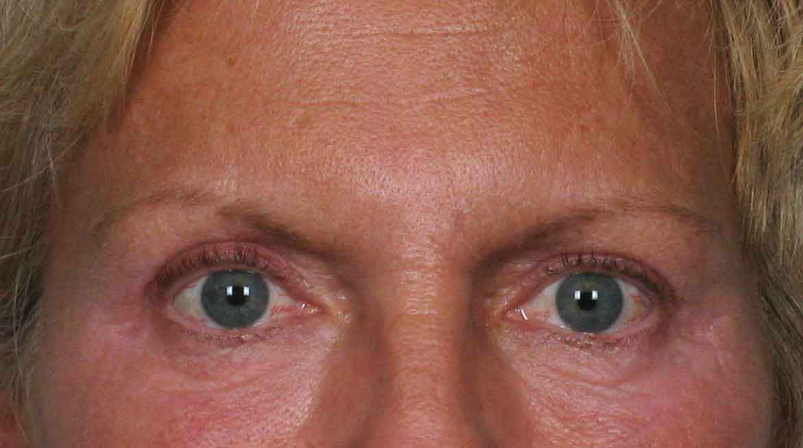 After-Eyelid Surgery - Blepharoplasty