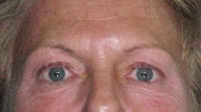 Before-Eyelid Surgery - Blepharoplasty