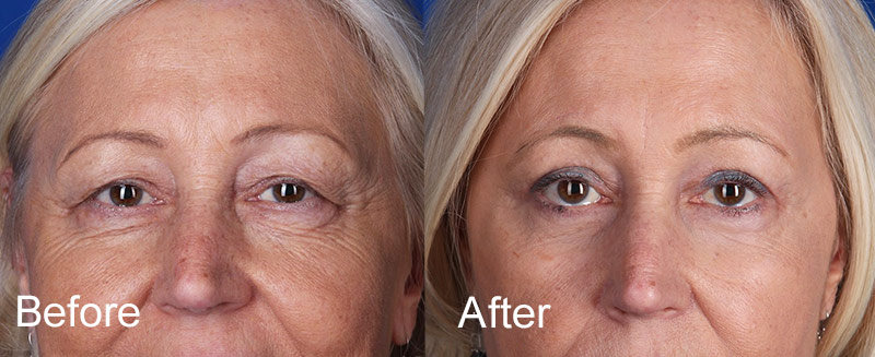Upper and Lower Eyelid Surgery Before and After