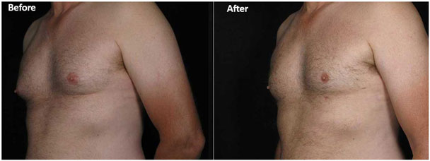 Male breast reduction at Contour Dermatology