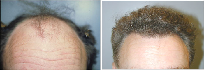 Neograft, Before and After Photo