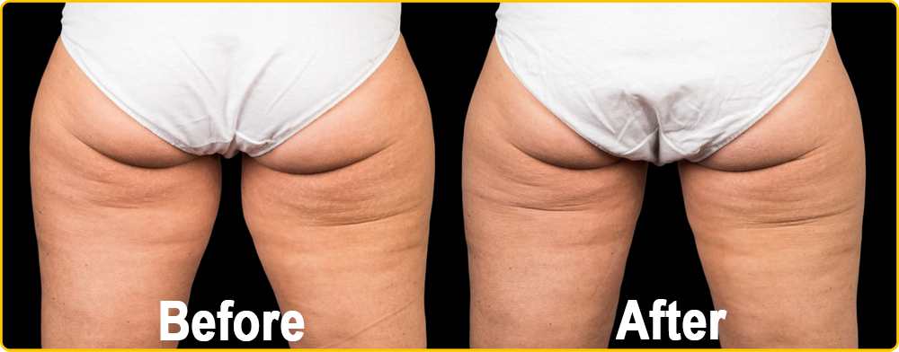 CoolSculpting for Inner & Outer Thighs at Contour Dermatology