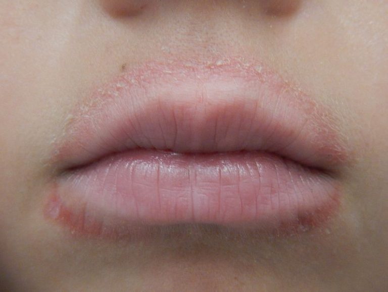 Dermatitis | Dermatólogo Contour