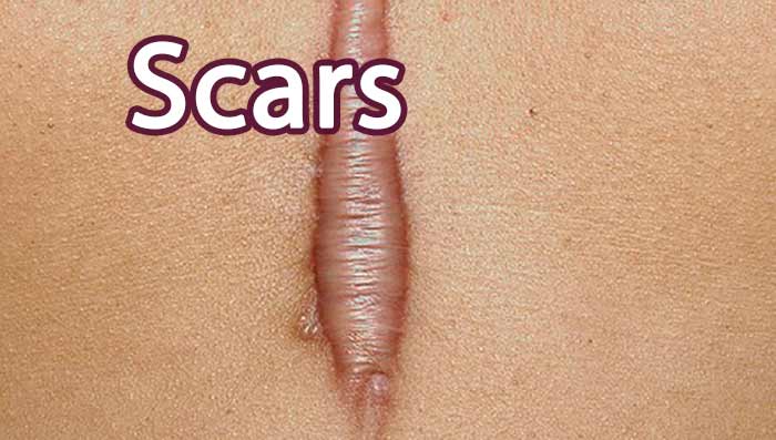 Scars and scar types