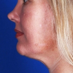 CoolSculpting for the double chin, after photo