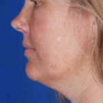 CoolSculpting for the double chin, before photo