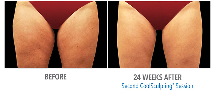 Our CoolSmooth Pro, CoolSculpting head is just the right size to take care of those irritating lumps and bumps on your outer thighs.