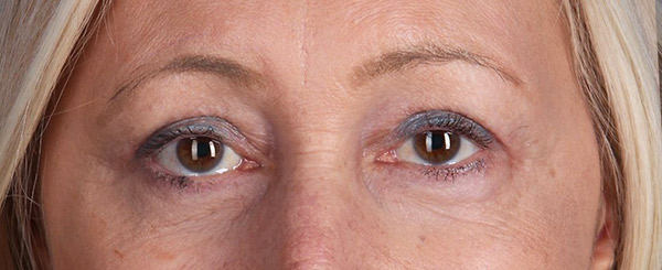After-Upper and Lower Eyelid Surgery