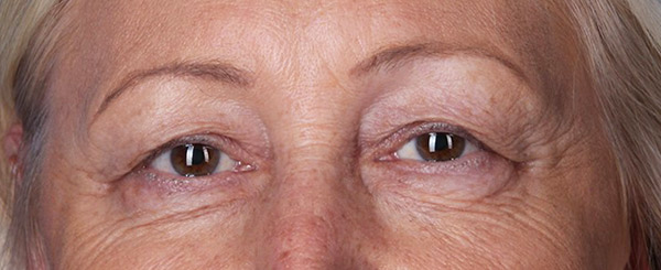 Before-Upper and Lower Eyelid Surgery