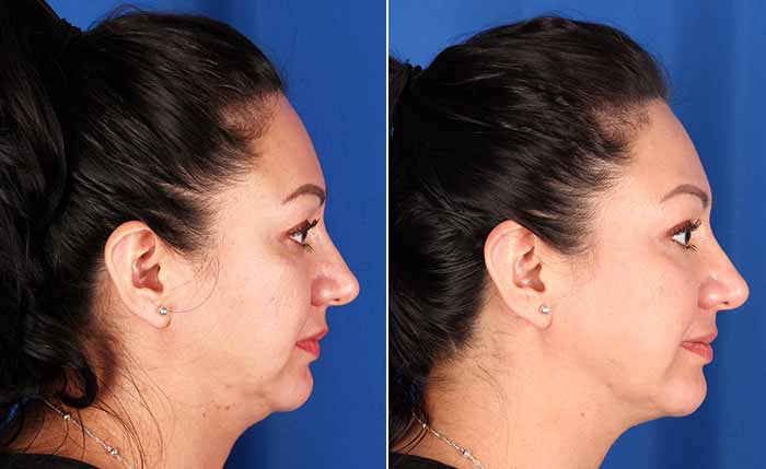 Resultados Profound antes y después para la cara y el cuello