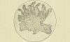 Condyloma Acuminata - verrugas genitales | Dermatólogo Contour