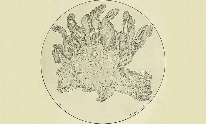Sección ampliada de baja potencia de Condylomata Acuminata Vulvae - Verrugas genitales