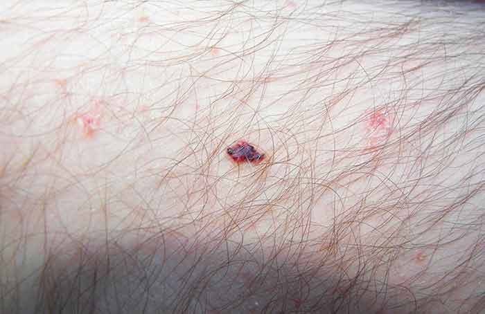 Angioma de cereza en la pierna